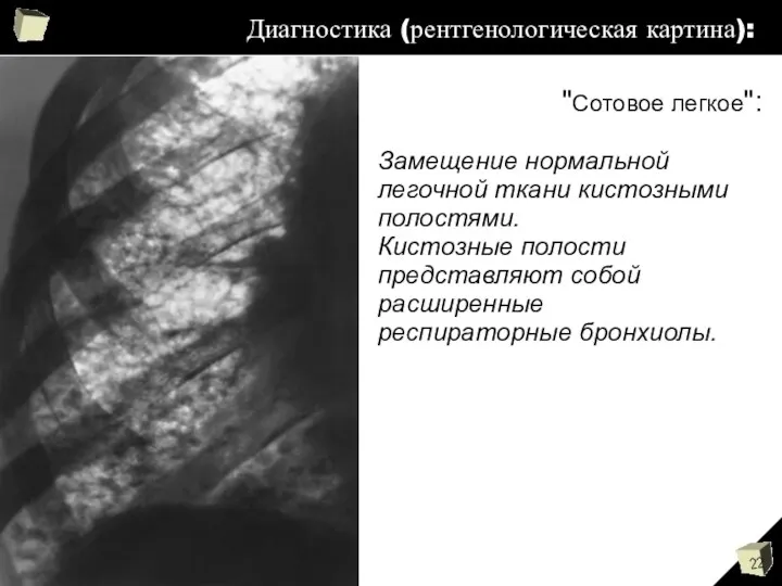 Диагностика (рентгенологическая картина): "Сотовое легкое": Замещение нормальной легочной ткани кистозными