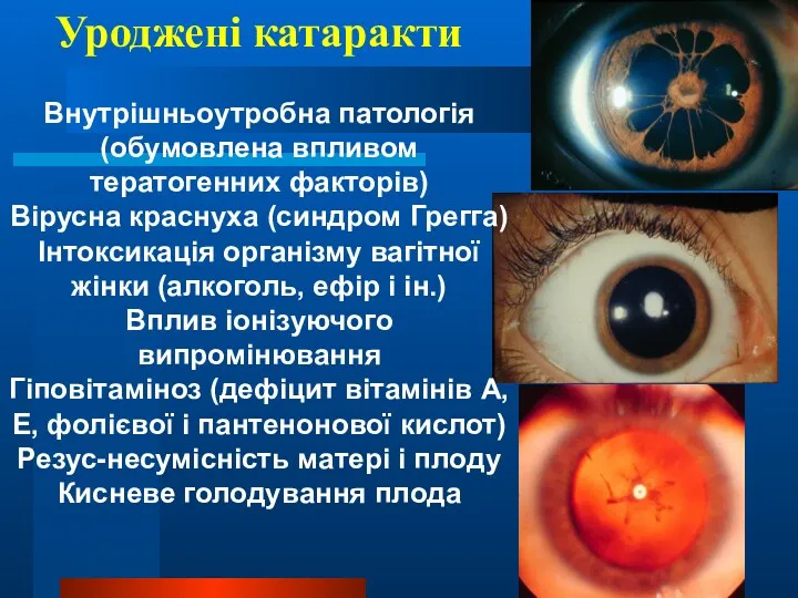 Уроджені катаракти Внутрішньоутробна патологія (обумовлена впливом тератогенних факторів) Вірусна краснуха