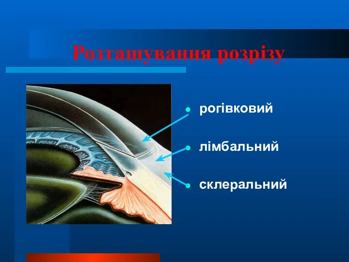 Розташування розрізу рогівковий лімбальний склеральний