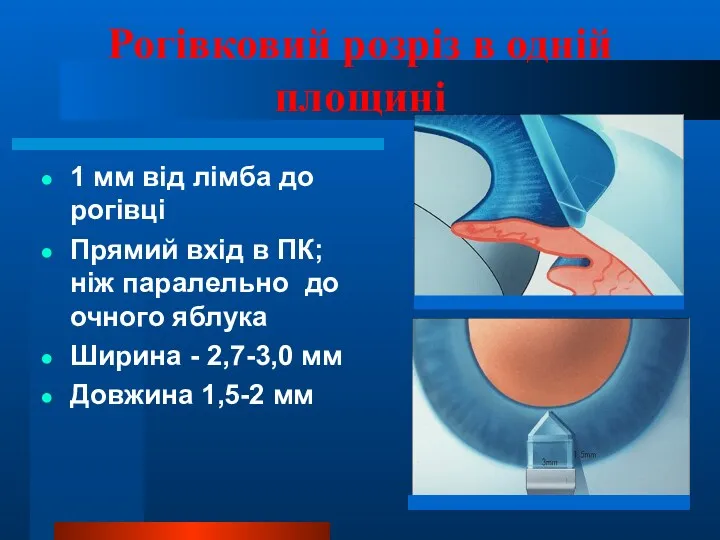 Рогівковий розріз в одній площині 1 мм від лімба до