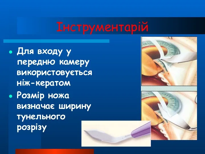 Інструментарій Для входу у передню камеру використовується ніж-кератом Розмір ножа визначає ширину тунельного розрізу