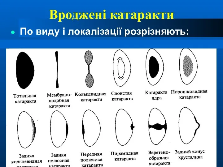 Вроджені катаракти По виду і локалізації розрізняють: