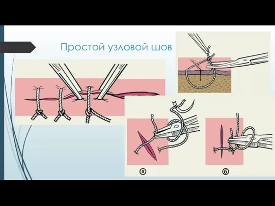 Простой узловой шов