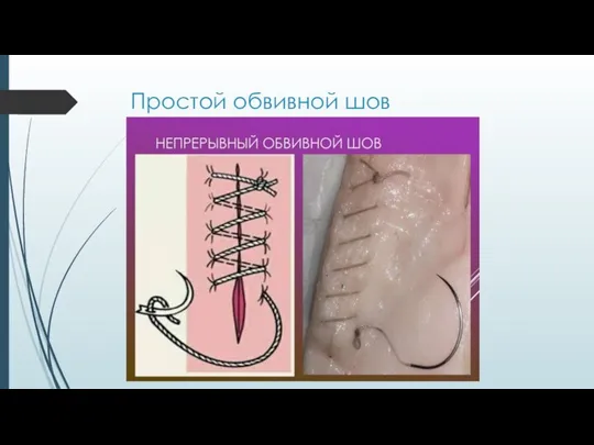 Простой обвивной шов