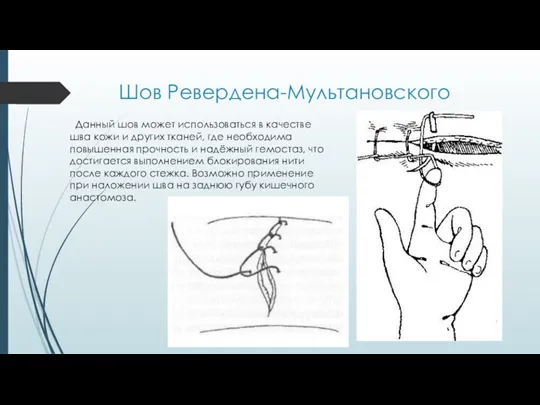 Шов Ревердена-Мультановского Данный шов может использоваться в качестве шва кожи