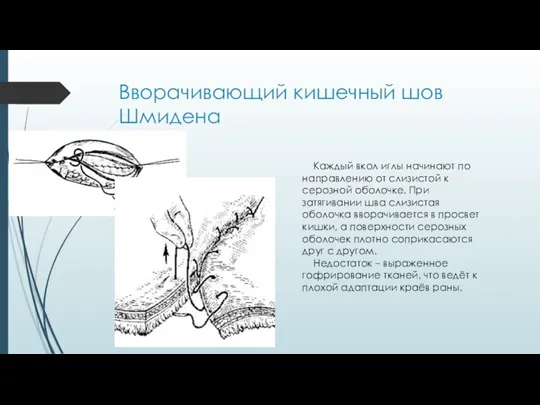 Вворачивающий кишечный шов Шмидена Каждый вкол иглы начинают по направлению