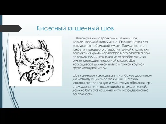 Кисетный кишечный шов Непрерывный серозно-мышечный шов, накладываемый циркулярно. Предназначен для