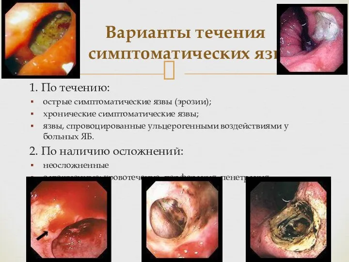 Варианты течения симптоматических язв 1. По течению: острые симптоматические язвы (эрозии); хронические симптоматические