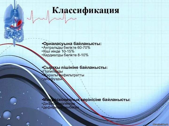 Классификация Орналасуына байланысты: Антральды бөлікте 60-70% Кіші иінде 10-15% Кардиалды