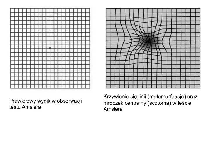 Krzywienie się linii (metamorfopsje) oraz mroczek centralny (scotoma) w teście