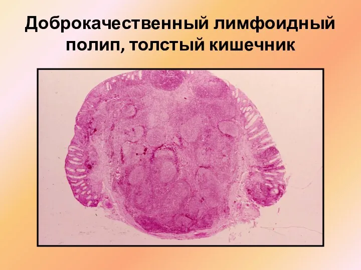 Доброкачественный лимфоидный полип, толстый кишечник