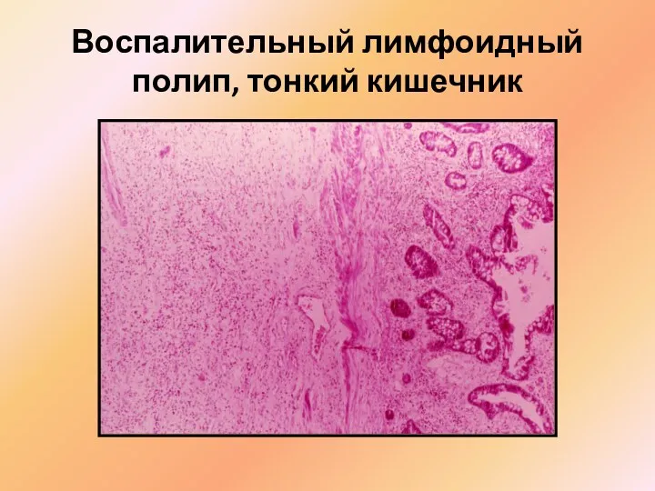 Воспалительный лимфоидный полип, тонкий кишечник