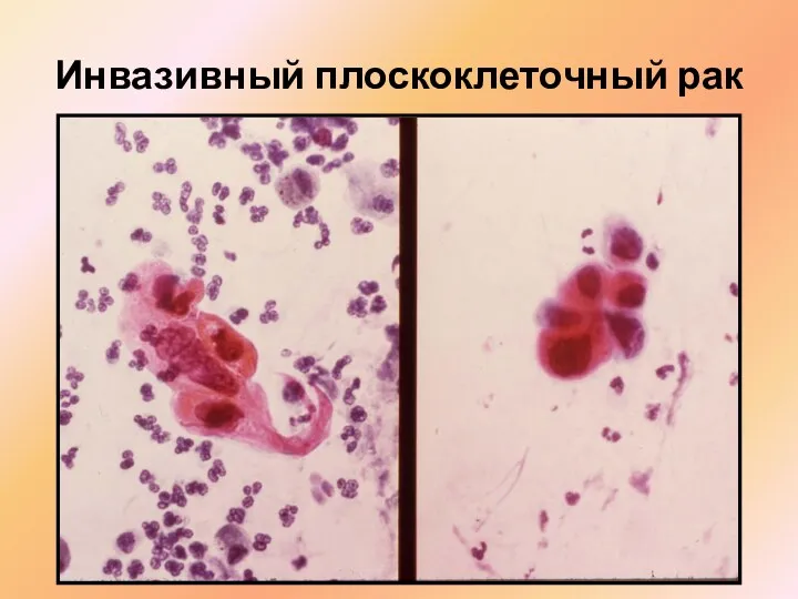 Инвазивный плоскоклеточный рак