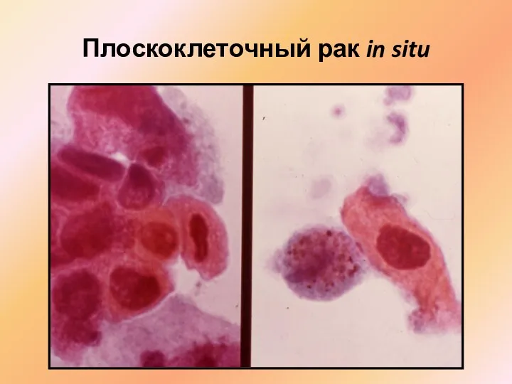 Плоскоклеточный рак in situ