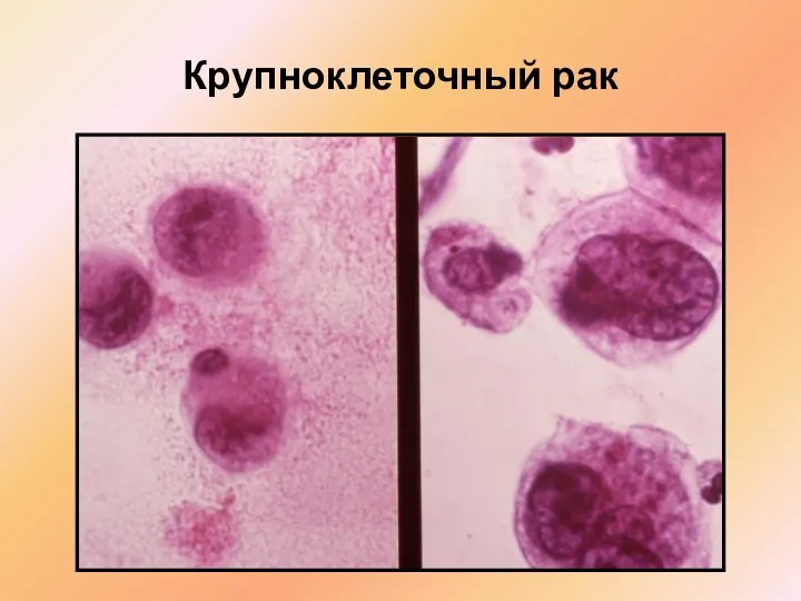 Крупноклеточный рак