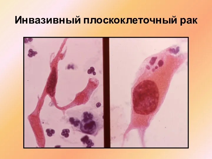 Инвазивный плоскоклеточный рак