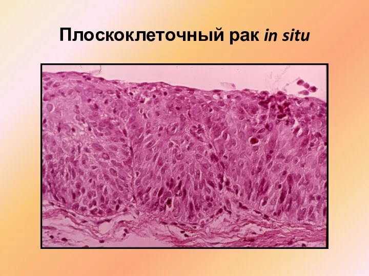 Плоскоклеточный рак in situ