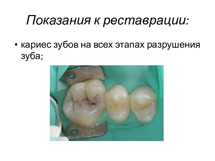 Показания к реставрации: кариес зубов на всех этапах разрушения зуба;
