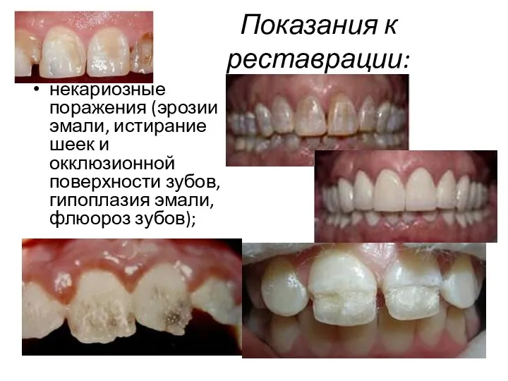 Показания к реставрации: некариозные поражения (эрозии эмали, истирание шеек и окклюзионной поверхности зубов,