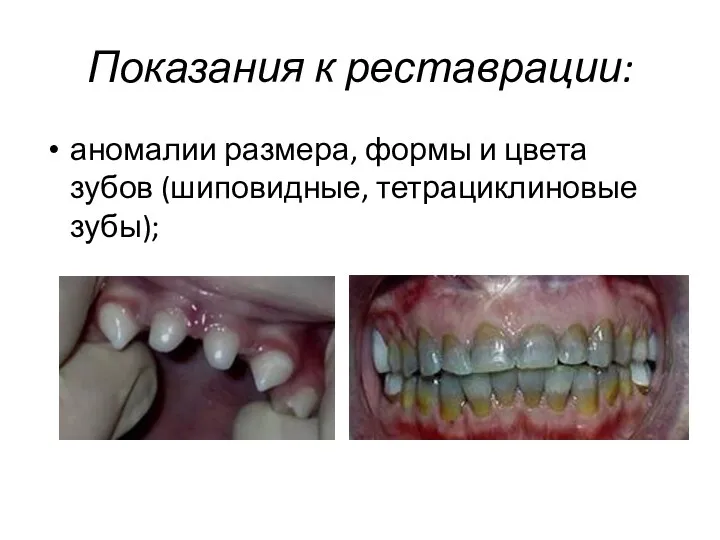 Показания к реставрации: аномалии размера, формы и цвета зубов (шиповидные, тетрациклиновые зубы);