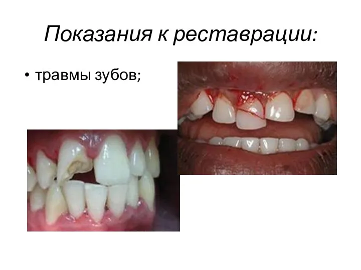 Показания к реставрации: травмы зубов;
