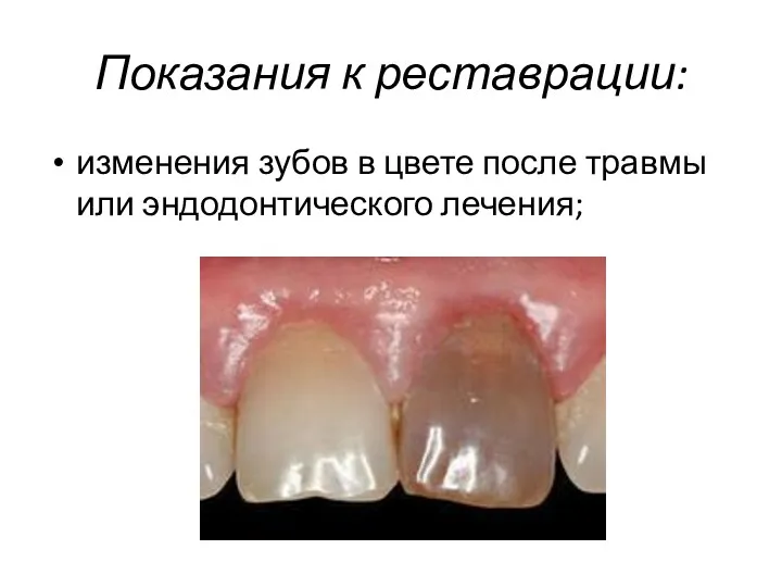 Показания к реставрации: изменения зубов в цвете после травмы или эндодонтического лечения;
