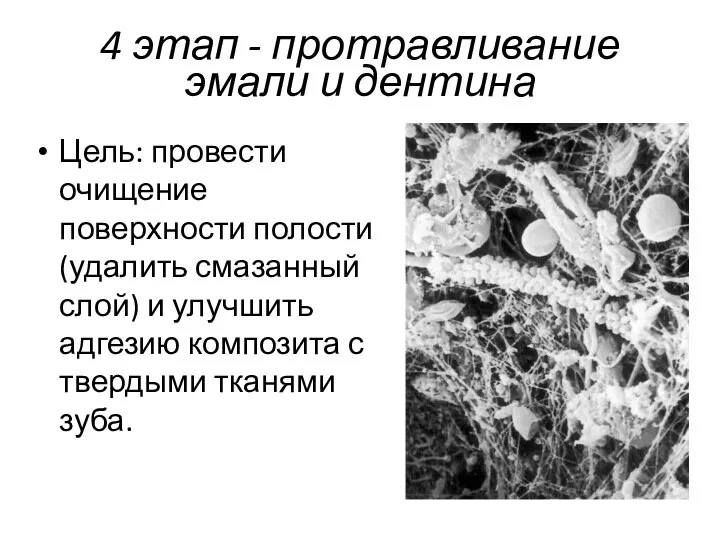 4 этап - протравливание эмали и дентина Цель: провести очищение поверхности полости (удалить