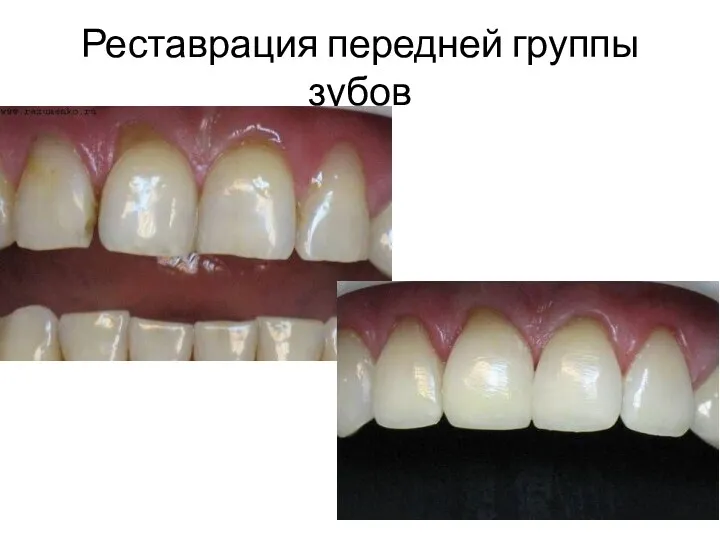 Реставрация передней группы зубов