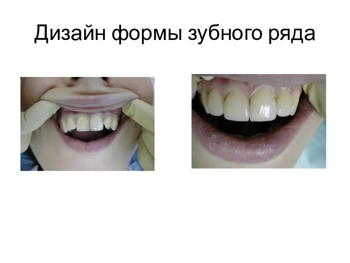 Дизайн формы зубного ряда