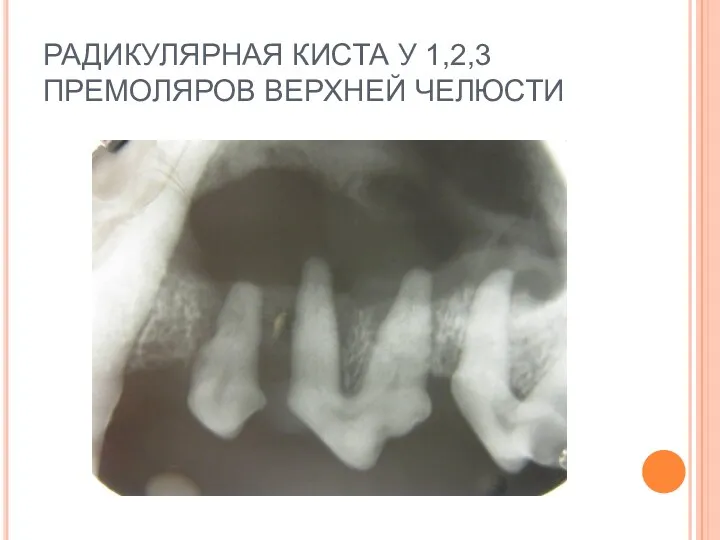 РАДИКУЛЯРНАЯ КИСТА У 1,2,3 ПРЕМОЛЯРОВ ВЕРХНЕЙ ЧЕЛЮСТИ