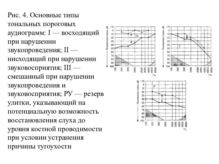 Рис. 4. Основные типы тональных пороговых аудиограмм: I — восходящий при нарушении звукопроведения;