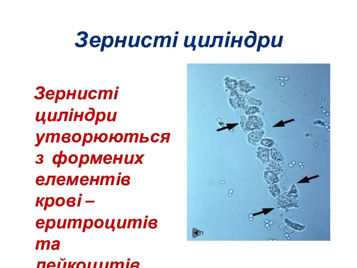 Зернисті циліндри Зернисті циліндри утворюються з формених елементів крові – еритроцитів та лейкоцитів.