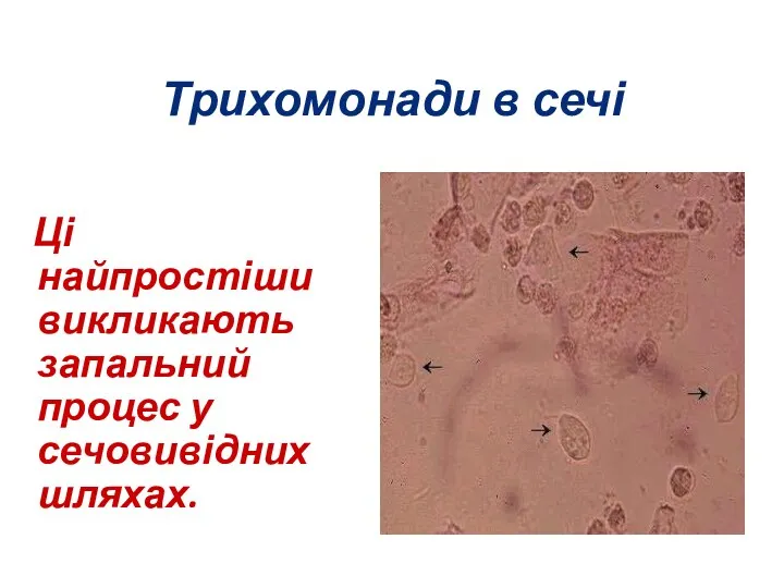 Трихомонади в сечі Ці найпростіши викликають запальний процес у сечовивідних шляхах.