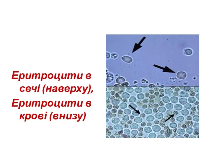 Еритроцити в сечі (наверху), Еритроцити в крові (внизу)