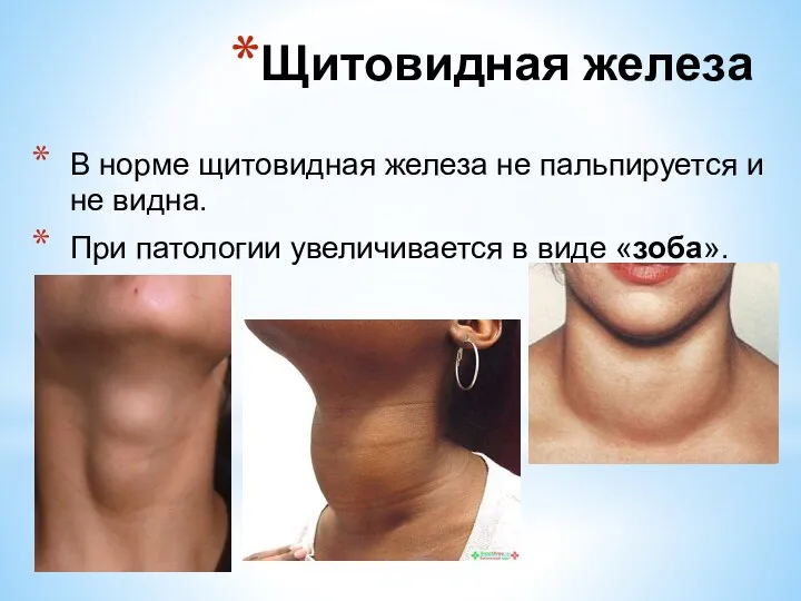 В норме щитовидная железа не пальпируется и не видна. При