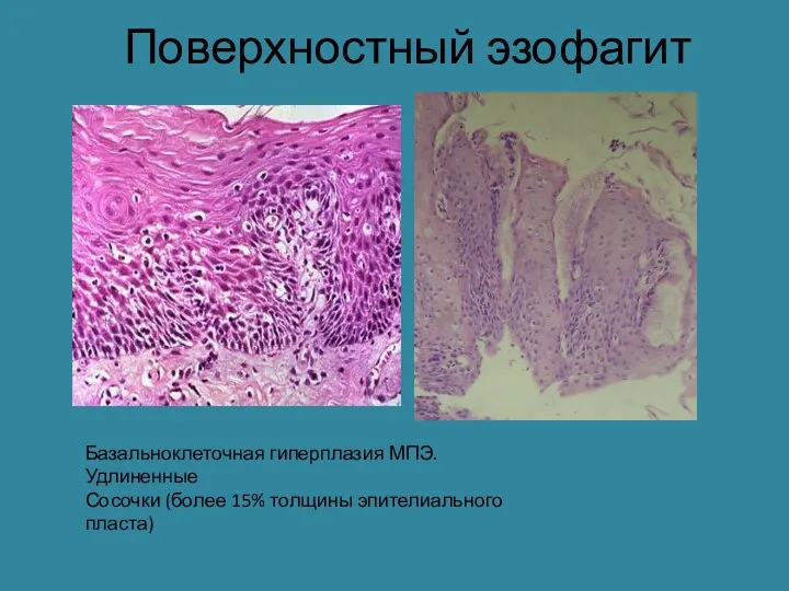 Поверхностный эзофагит Базальноклеточная гиперплазия МПЭ. Удлиненные Сосочки (более 15% толщины эпителиального пласта)