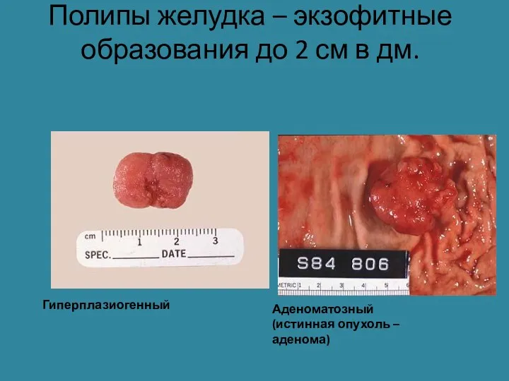 Полипы желудка – экзофитные образования до 2 см в дм. Гиперплазиогенный Аденоматозный (истинная опухоль – аденома)