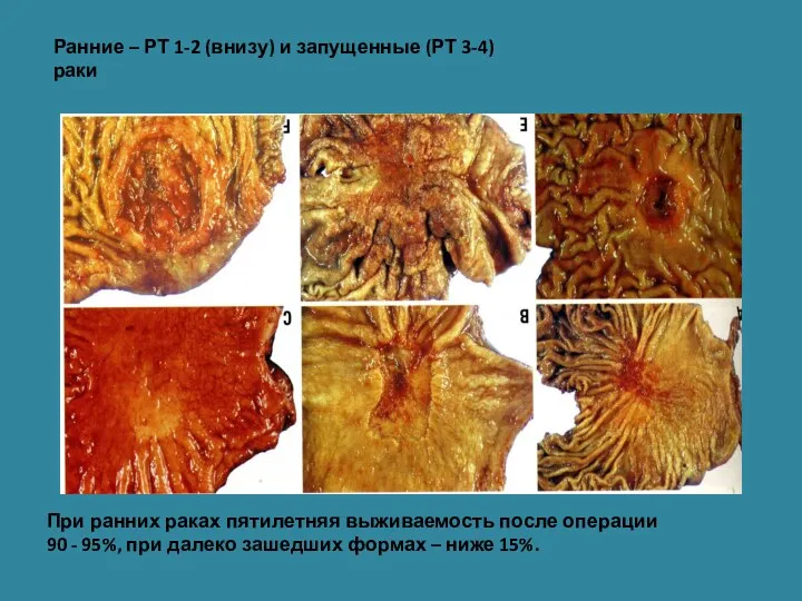 Ранние – РТ 1-2 (внизу) и запущенные (РТ 3-4) раки При ранних раках