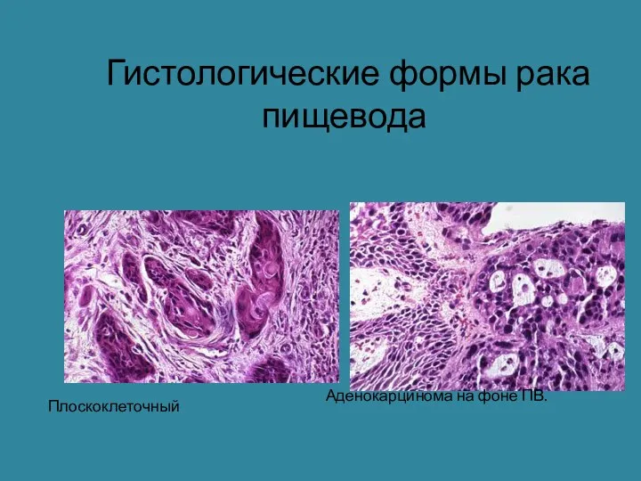 Гистологические формы рака пищевода Плоскоклеточный Аденокарцинома на фоне ПВ.