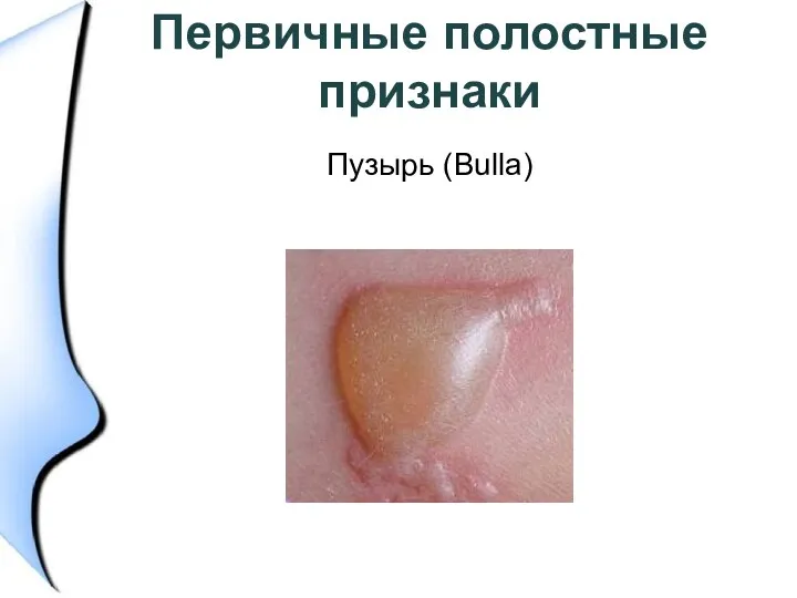 Первичные полостные признаки Пузырь (Bulla)