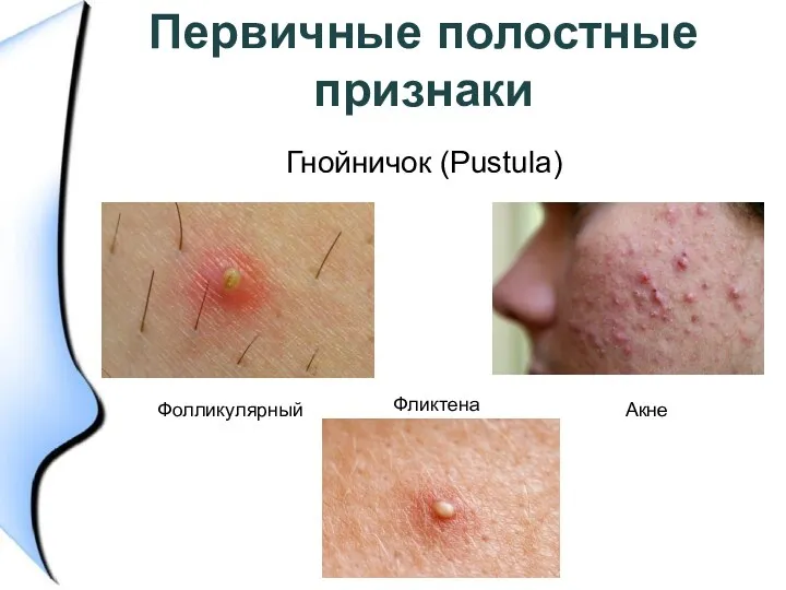 Первичные полостные признаки Гнойничок (Pustula) Акне Фолликулярный Фликтена