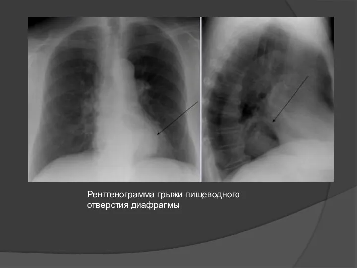 Рентгенограмма грыжи пищеводного отверстия диафрагмы