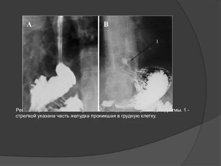 Рентгенограмма больного с грыжей пищеводного отверстия диафрагмы. 1 - стрелкой