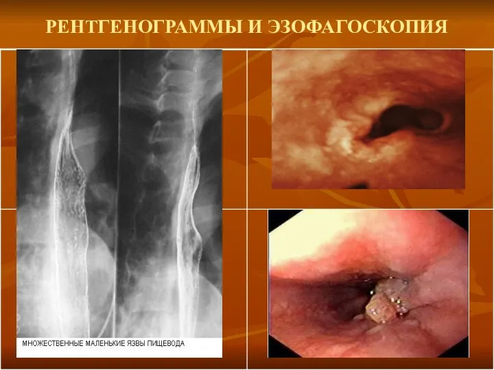 РЕНТГЕНОГРАММЫ И ЭЗОФАГОСКОПИЯ