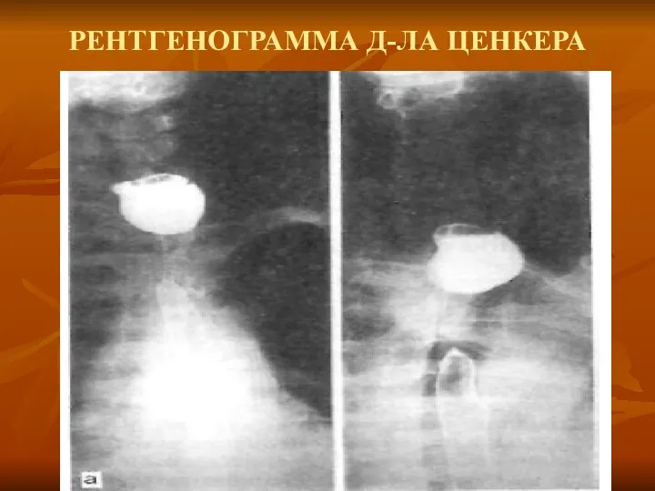 РЕНТГЕНОГРАММА Д-ЛА ЦЕНКЕРА