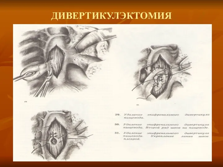 ДИВЕРТИКУЛЭКТОМИЯ