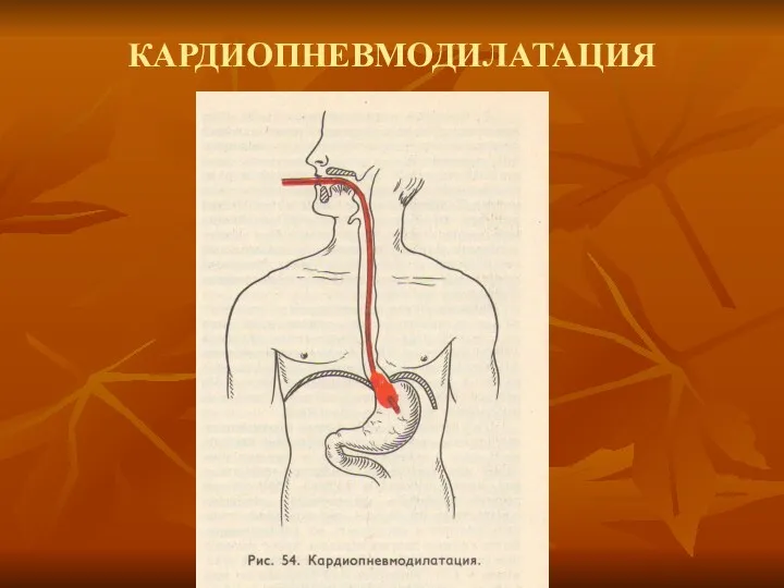 КАРДИОПНЕВМОДИЛАТАЦИЯ