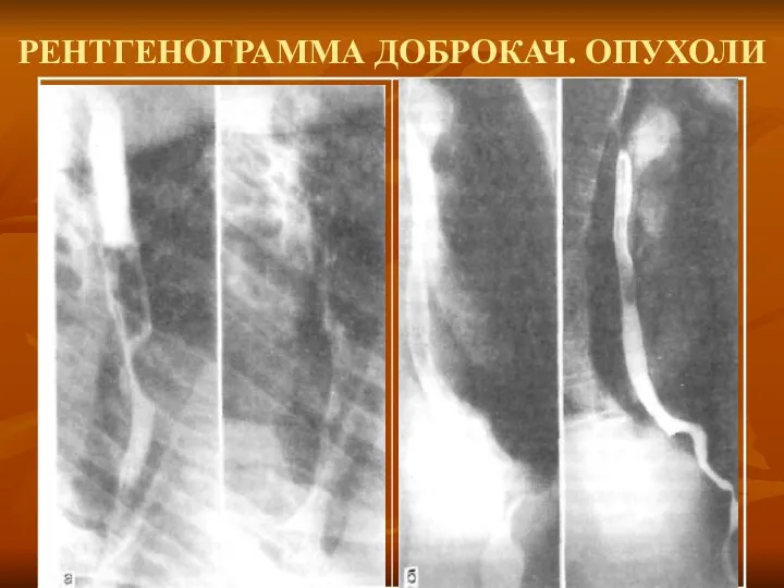 РЕНТГЕНОГРАММА ДОБРОКАЧ. ОПУХОЛИ