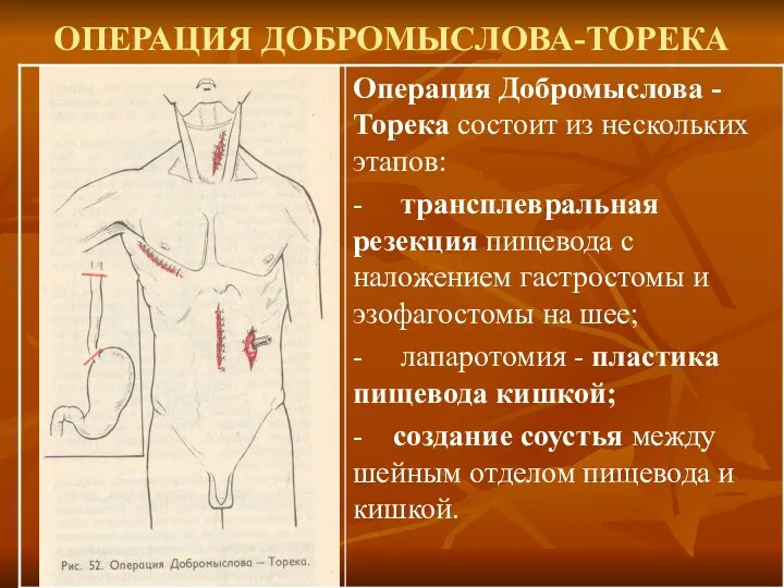 ОПЕРАЦИЯ ДОБРОМЫСЛОВА-ТОРЕКА