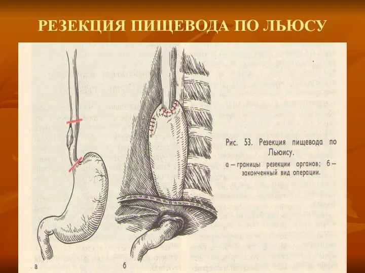 РЕЗЕКЦИЯ ПИЩЕВОДА ПО ЛЬЮСУ